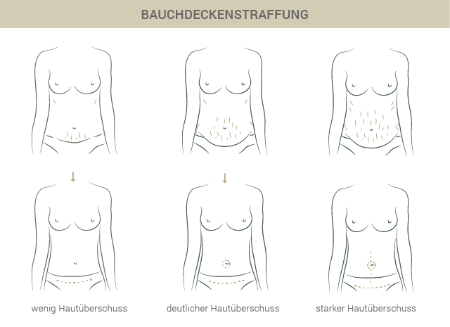 Graphik Bauchdeckenstraffung - Dr. Babak Esfahani Köln 