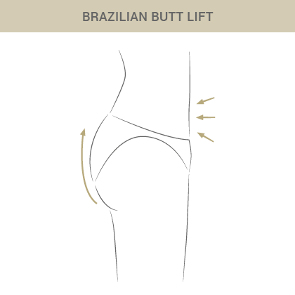 Graphik zu Brazilian Butt Lift - Dr. Esfahani in Köln 