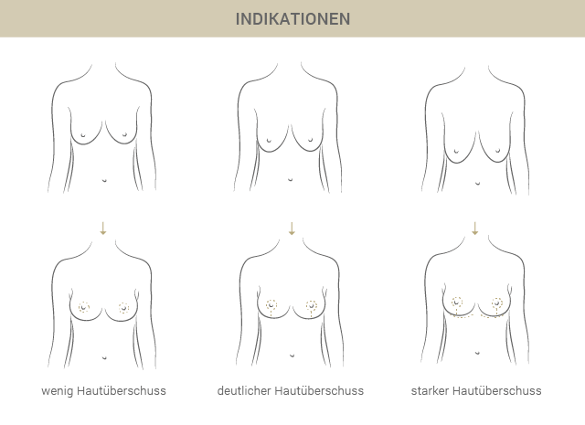 Graphik zu Bruststraffung Indikationen - Dr. Esfahani in Köln 