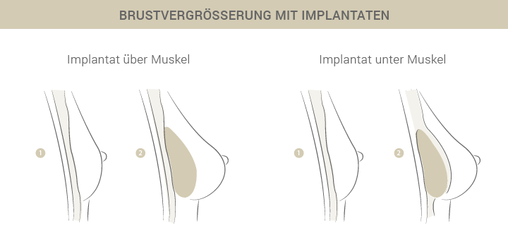 Graphik zur Brustvergrößerung mit Implantaten - Dr. Esfahani Köln 