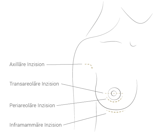 Schnittführung bei der Brustvergrößerung mit Implantaten - Dr. Esfahani Köln 