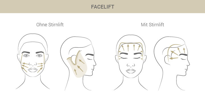 Graphik zum Facelift - Dr. Esfahani in Köln 