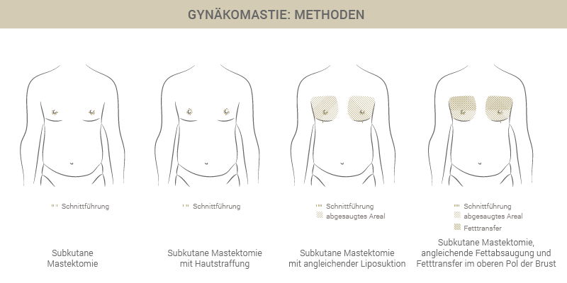 Graphik zu Gynäkomastie Methoden - Dr. Esfahani Köln 