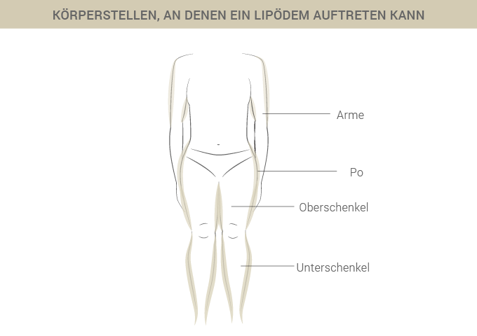 Graphik zu Lipödem Körperstellen - Dr. Esfahani in Köln 