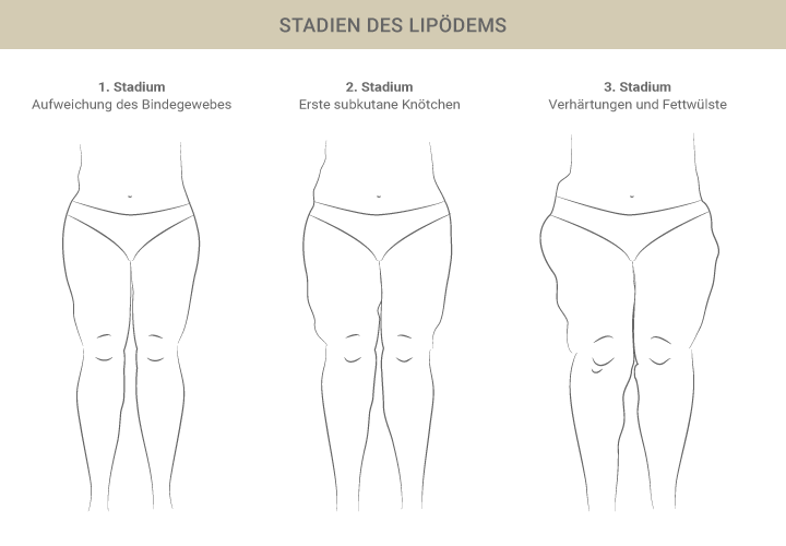 Graphik zu Lipödem Stadien - Dr. Esfahani in Köln