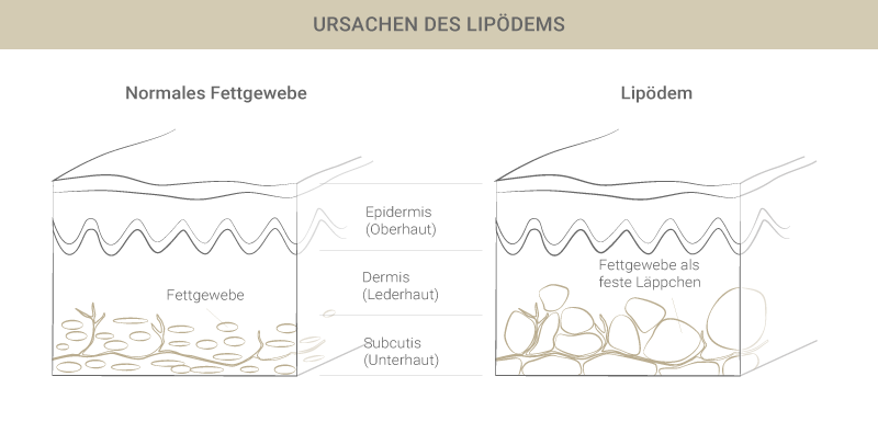 Graphik zu Lipödem Ursachen - Dr. Esfahani in Köln